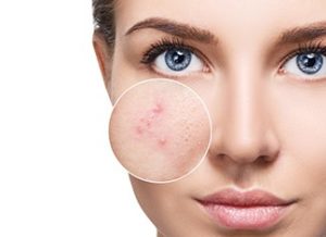 Acne-skin
